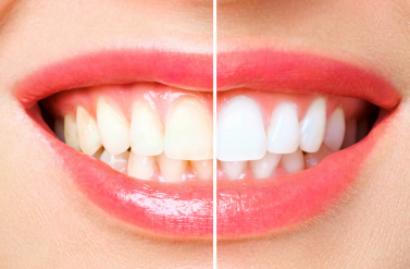 wybielanie zębów dentysta Białystok