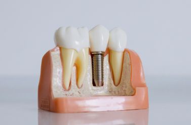 7 mitów o implantach zębowych