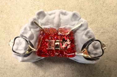 Aparat ortodontyczny dla dzieci Marco Rosa ortodonta Białystok