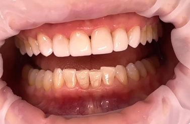 bonding zębów Krętowska Stomatologia