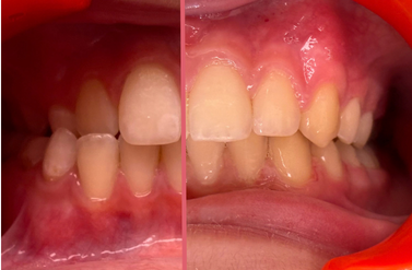 metamorfoza uśmiechu dentysta Białystok